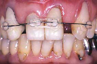 <p>歯が移動し、前の歯のすき間が閉鎖</p>
